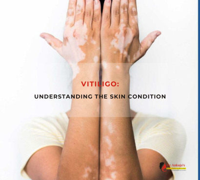 Vitiligo