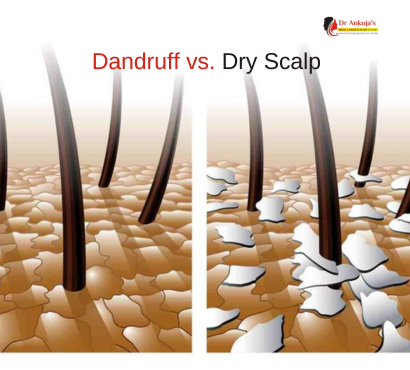 Dandruff-Dry-Scalp