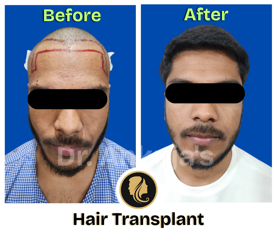 hair-transplant-before-after