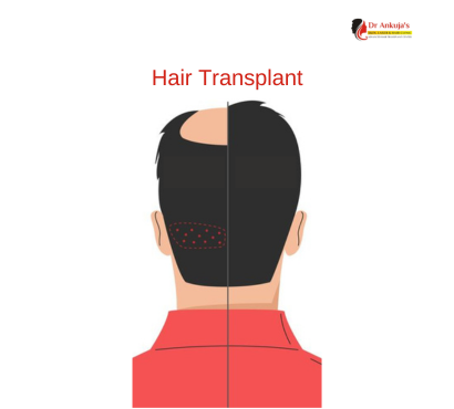 hair-transplant