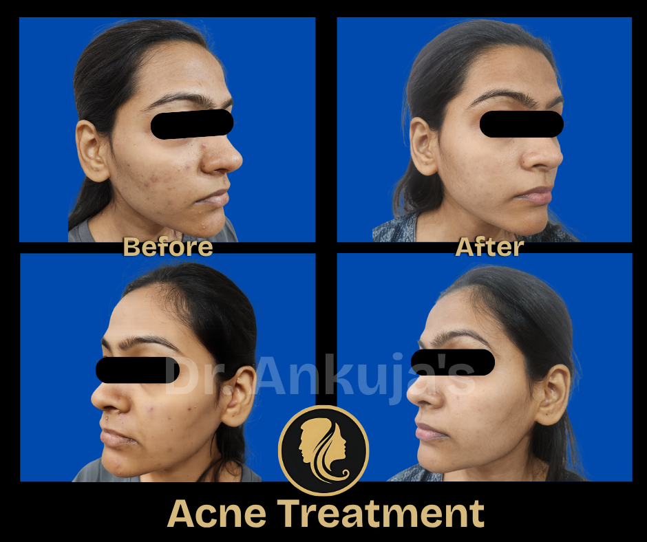 skin treatment results
