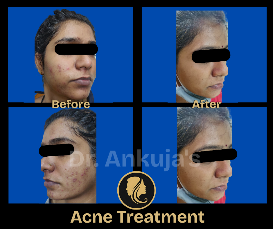 skin treatment results
