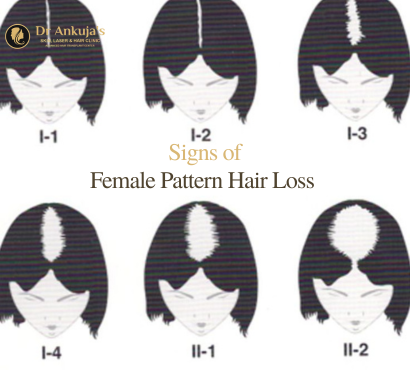female-pattern-hair-loss