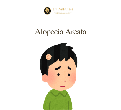 Alopecia-Areata