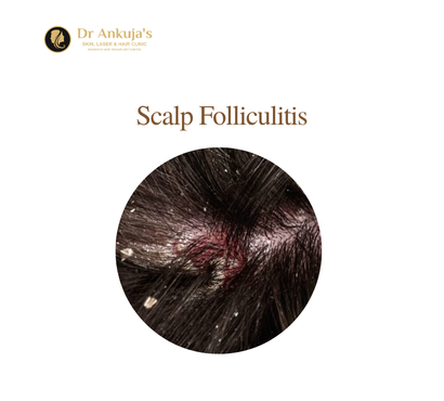 Scalp-Folliculitis
